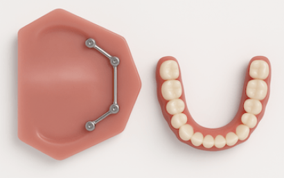 Prótesis removible que se adapta a ti