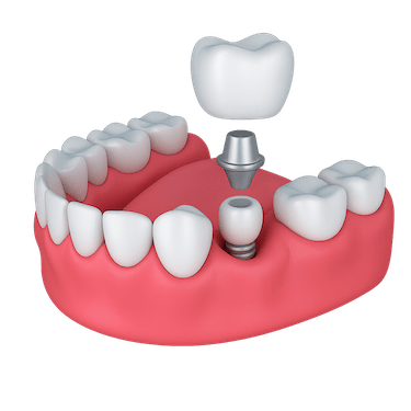 ¿Qué es una corona sobre implante?