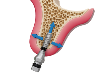 Falta de anchura en hueso para implantes