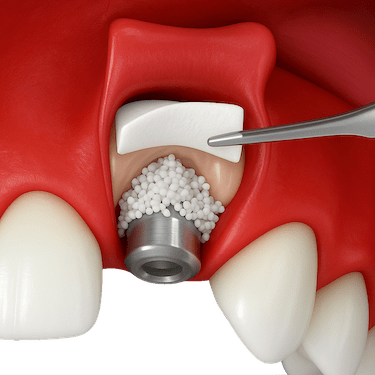 ¿Qué es la expansión ósea?